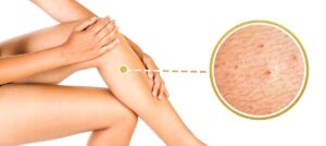 Illustration d’irritations et de boutons autour des poils